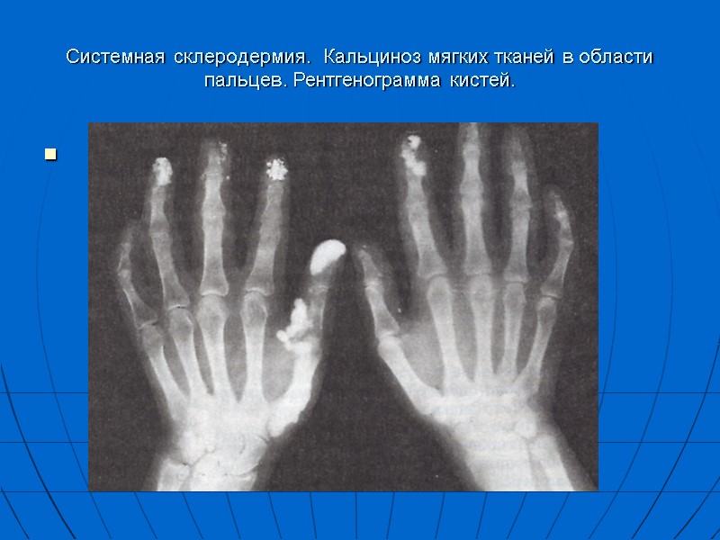 Системная склеродермия.  Кальциноз мягких тканей в области пальцев. Рентгенограмма кистей.